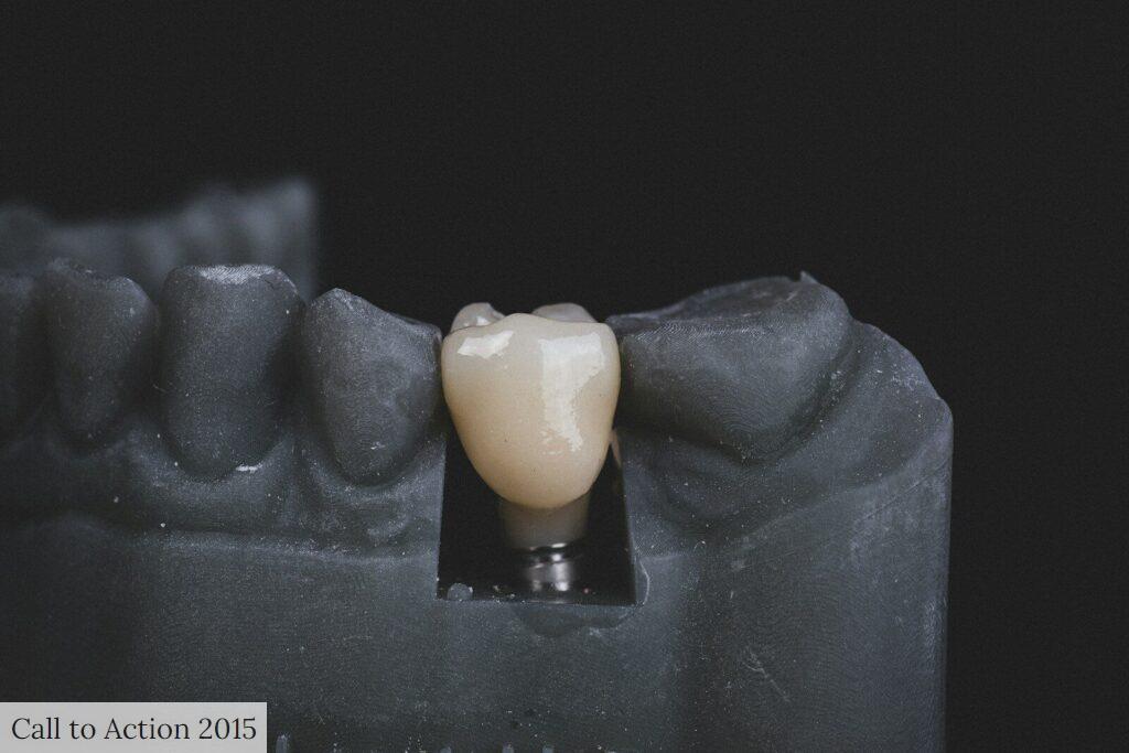 dudas antes de un implante dental