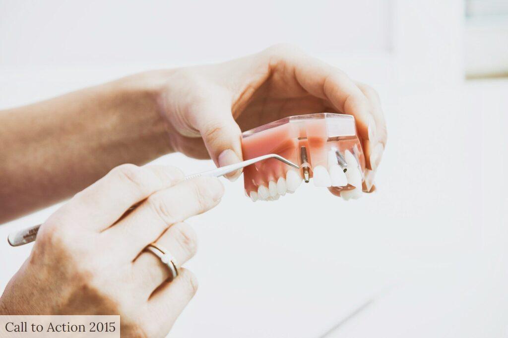 dudas más comunes antes de un implante dental