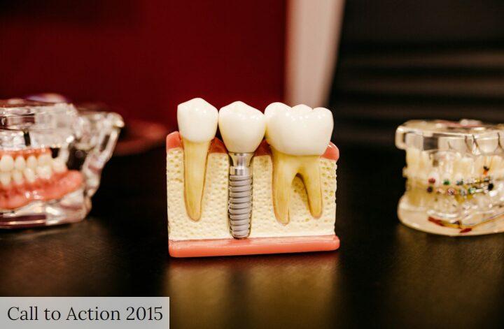 Las 7 dudas más comunes antes de un implante dental